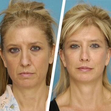 A experiência de Natalia de Kyiv, foto antes e depois de usar Intenskin