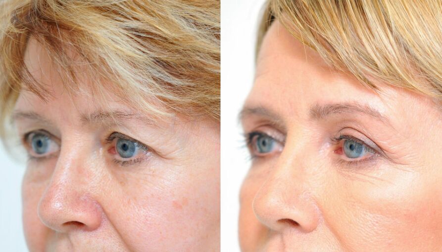 blefaroplastia-antes e depois