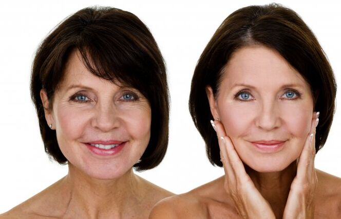 Antes e depois do levantamento de RF