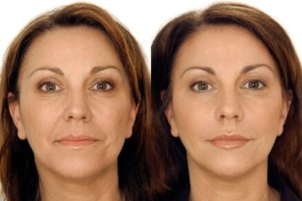 Massagem de GLP do rosto antes e depois