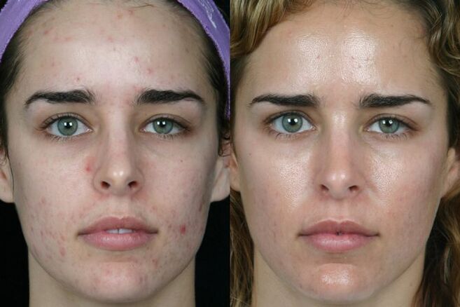 Moagem a laser da pele do rosto antes e depois