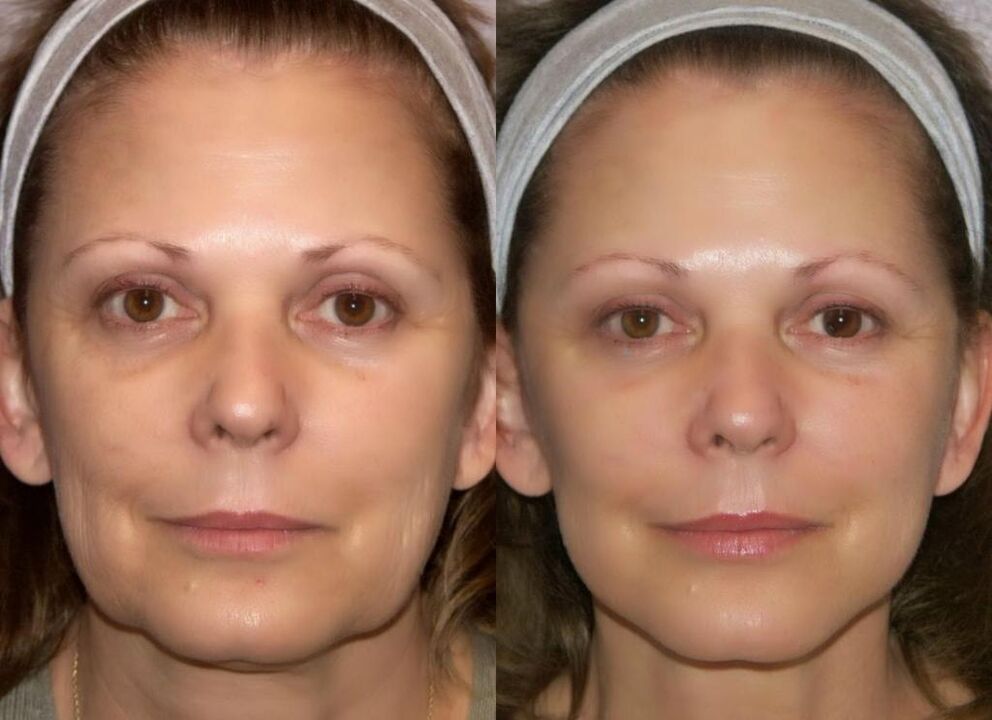 Rosto antes e depois do rejuvenescimento do hardware
