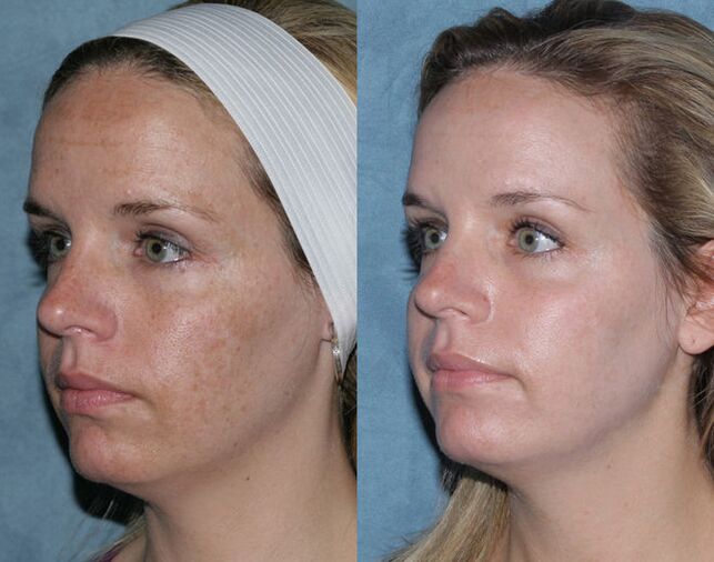 Foto antes e depois do rejuvenescimento fracionário do rosto